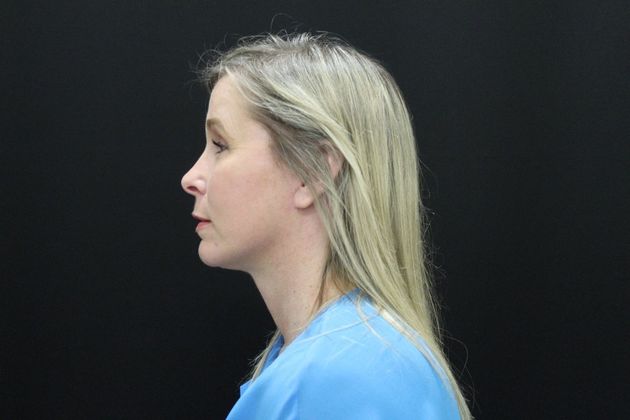 Face & Neck Lifts: Case 11 - After