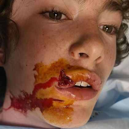 Facial Laceration Repair Case 18 Laceration repair, Rye, NY - Before