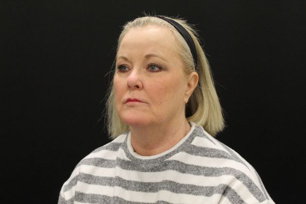 Face & Neck Lifts: Case 10 - Before