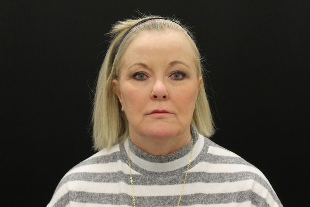 Face & Neck Lifts: Case 10 - Before