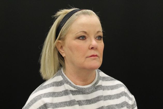 Face & Neck Lifts: Case 10 - Before