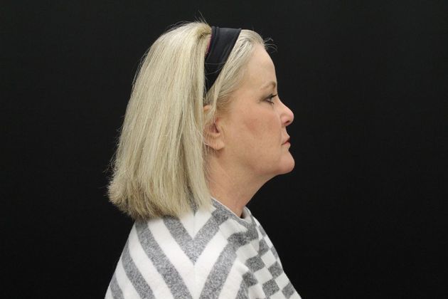 Face & Neck Lifts: Case 10 - Before