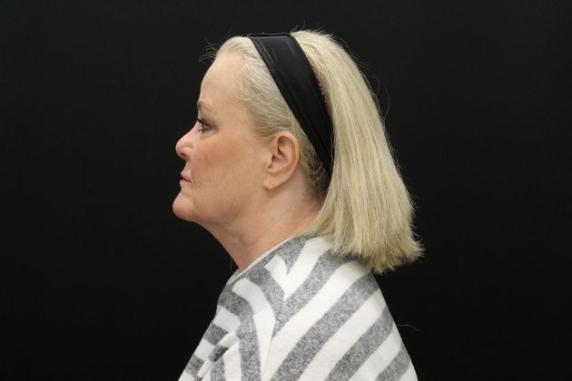 Face & Neck Lifts: Case 10 - Before