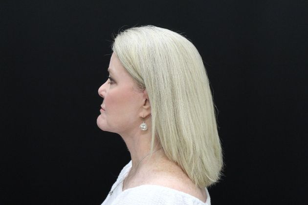 Face & Neck Lifts: Case 10 - After