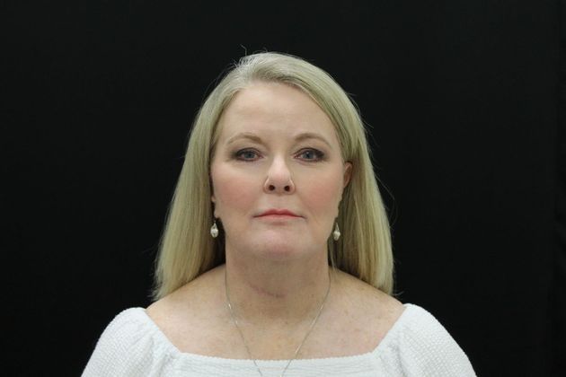 Face & Neck Lifts: Case 10 - After