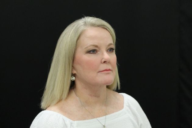 Face & Neck Lifts: Case 10 - After