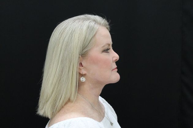 Face & Neck Lifts: Case 10 - After
