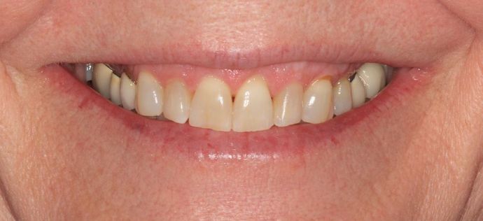 Full Mouth Reconstruction: Case 14 - Before