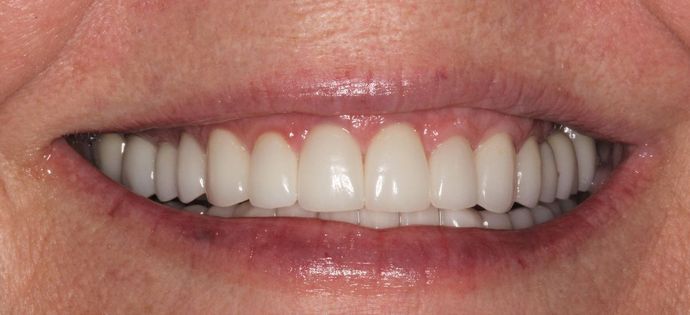 Full Mouth Reconstruction: Case 14 - After