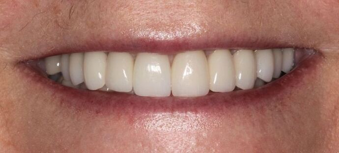 Full Mouth Reconstruction: Case 15