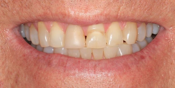 Full Mouth Reconstruction: Case 16 - Before