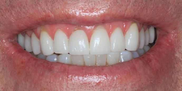 Full Mouth Reconstruction: Case 16 - After