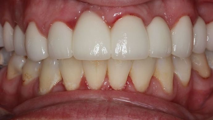 Dental Crowns: Case 28 - After