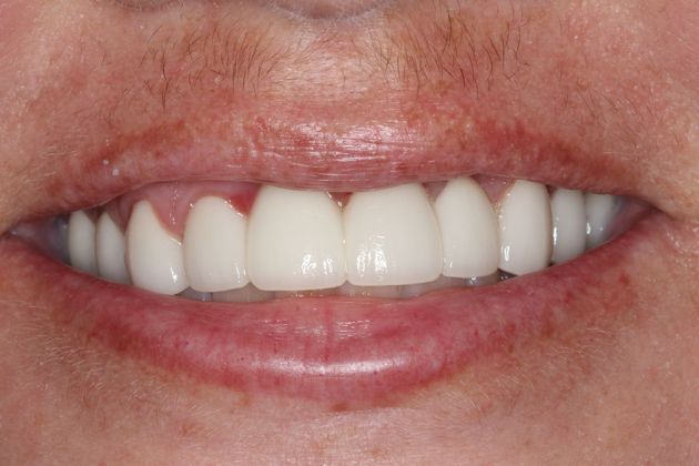 Dental Crowns Case 28 - After