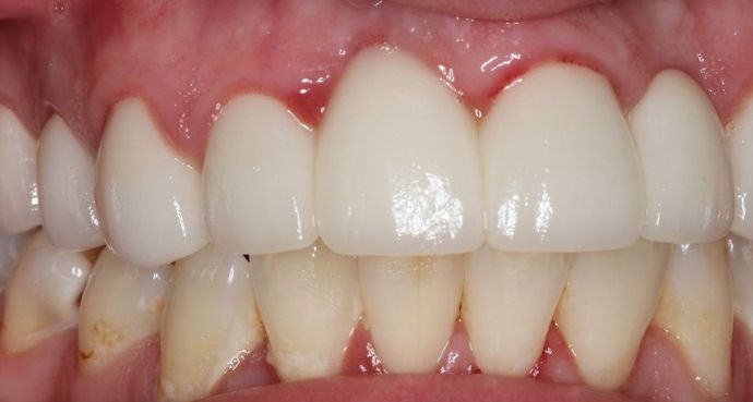 Dental Crowns: Case 28 - Before