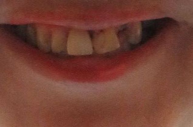 Dental Crowns Case 28 - Before