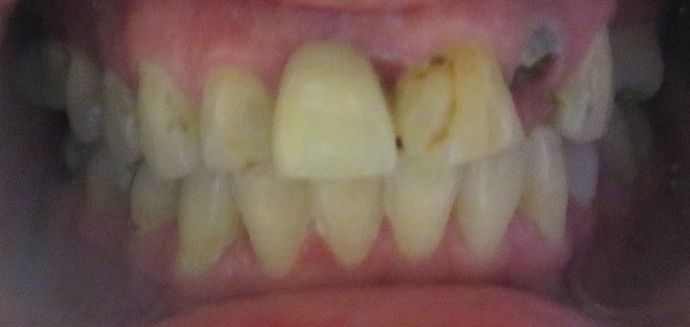 Dental Crowns: Case 28 - Before
