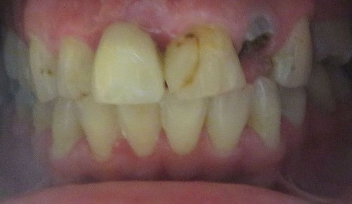 Dental Crowns: Case 28 - After