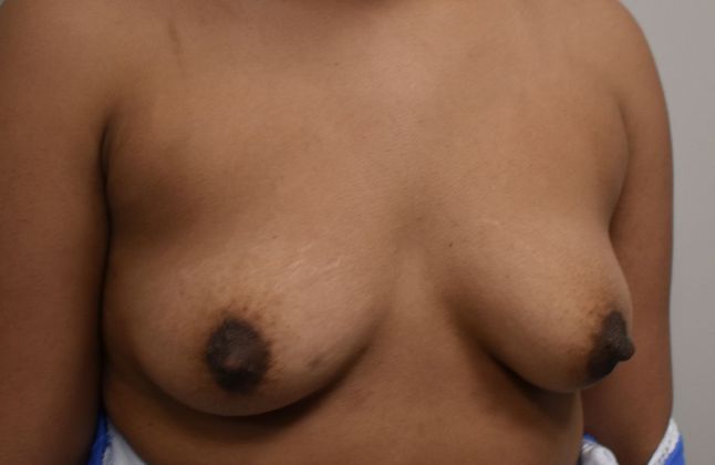 Breast Augmentation w/ Lift: Case 358 - Before