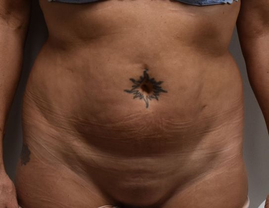 Tummy Tuck (Abdominoplasty): Case 283 - Before