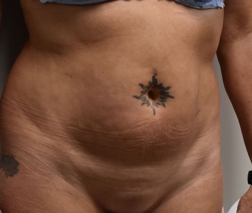 Tummy Tuck (Abdominoplasty): Case 283 - Before