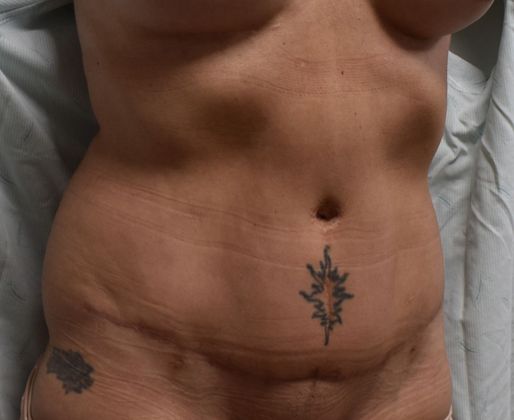 Tummy Tuck (Abdominoplasty): Case 283 - After