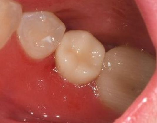 Crowns Case 18 - Victoria, TX - After