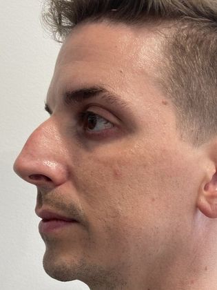 Rhinoplasty: Case 26 Rhinoplasty Septoplasty Fairfield - Before