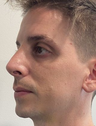 Rhinoplasty: Case 26 Rhinoplasty Septoplasty Fairfield - After