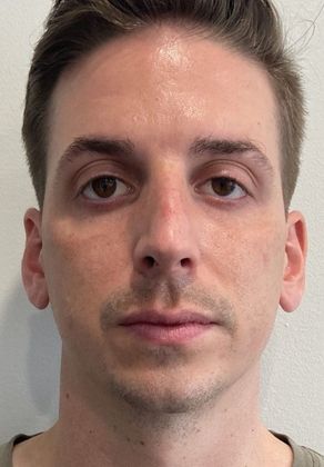 Rhinoplasty: Case 26 Rhinoplasty Septoplasty Fairfield - Before