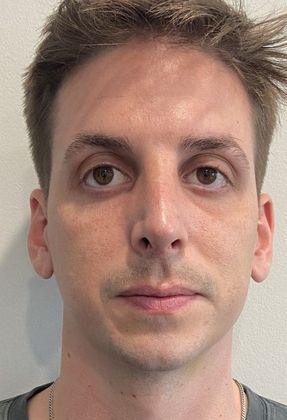 Rhinoplasty: Case 26 Rhinoplasty Septoplasty Fairfield - After