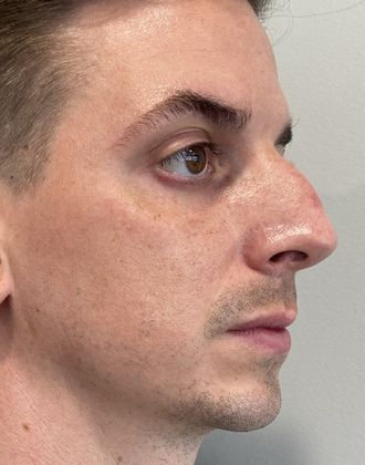 Rhinoplasty: Case 26 Rhinoplasty Septoplasty Fairfield - Before