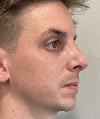 Rhinoplasty: Case 26 Rhinoplasty Septoplasty Fairfield - After