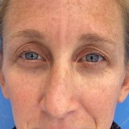 Eyelid Lift: Case 26 Eyelid Lift Westport, CT - Before