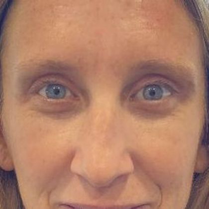 Eyelid Lift: Case 26 Eyelid Lift Westport, CT - After