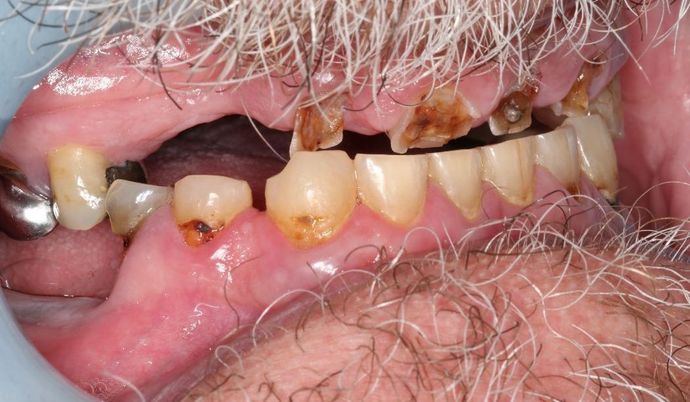 Dentures: Case 4 - Before