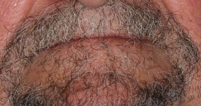 Dentures Case 4 - Before