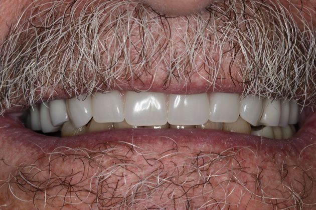 Dentures Case 4 - After