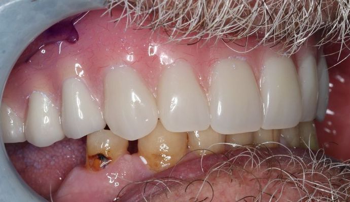Dentures: Case 4 - After