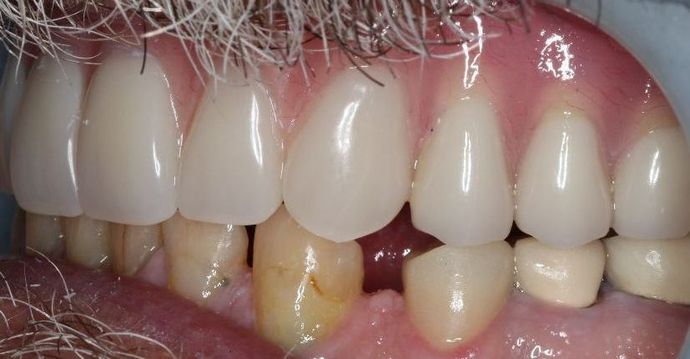Dentures: Case 4 - After