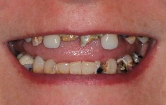 Teeth In A Day Case 22 - Before