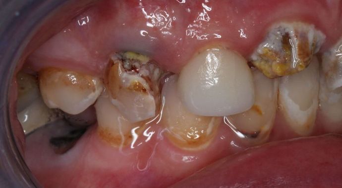 Teeth In A Day: Case 22 - Before