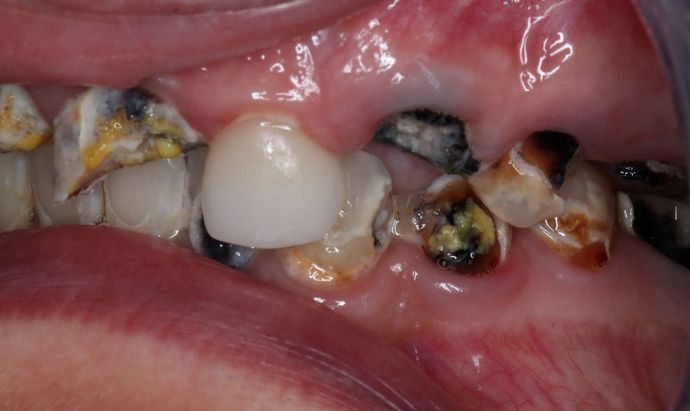 Teeth In A Day: Case 22 - Before