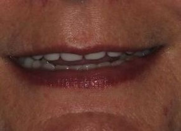 Teeth In A Day: Case 22 - After