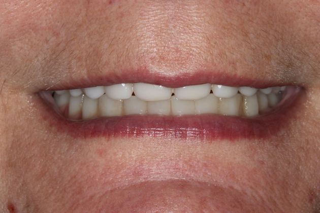 Teeth In A Day: Case 22 - After