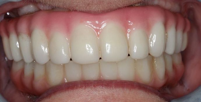 Teeth In A Day Case 22 - After