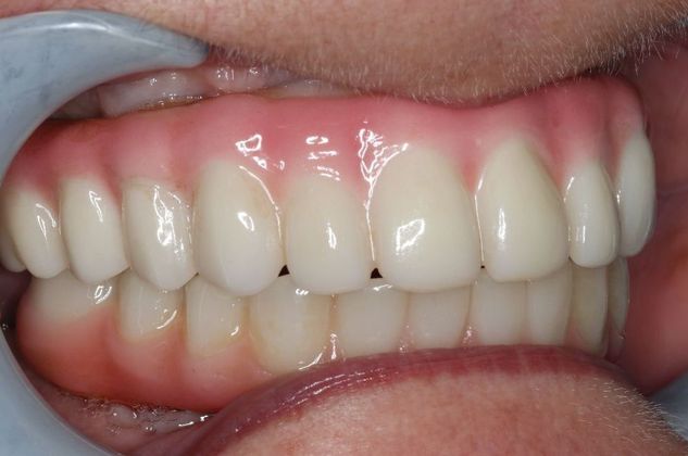 Teeth In A Day: Case 22 - After