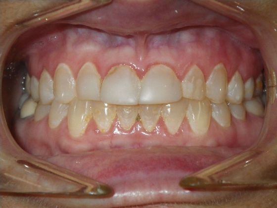 Cosmetic Changes with Veneers and Crown and Bridge: Case 2 - Before