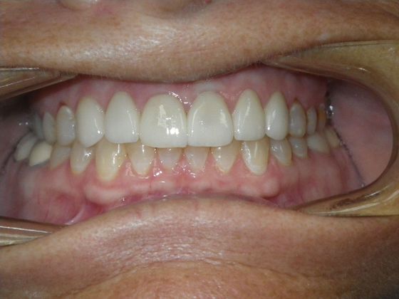 Cosmetic Changes with Veneers and Crown and Bridge: Case 2 - After