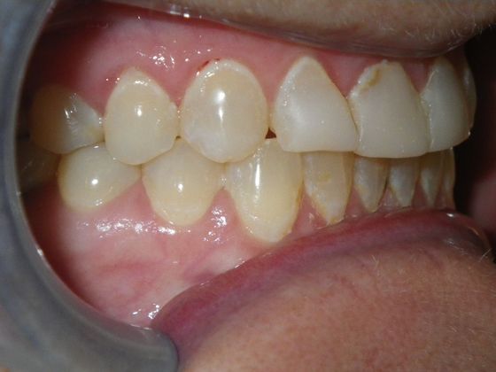 Cosmetic Changes with Veneers and Crown and Bridge: Case 2 - Before